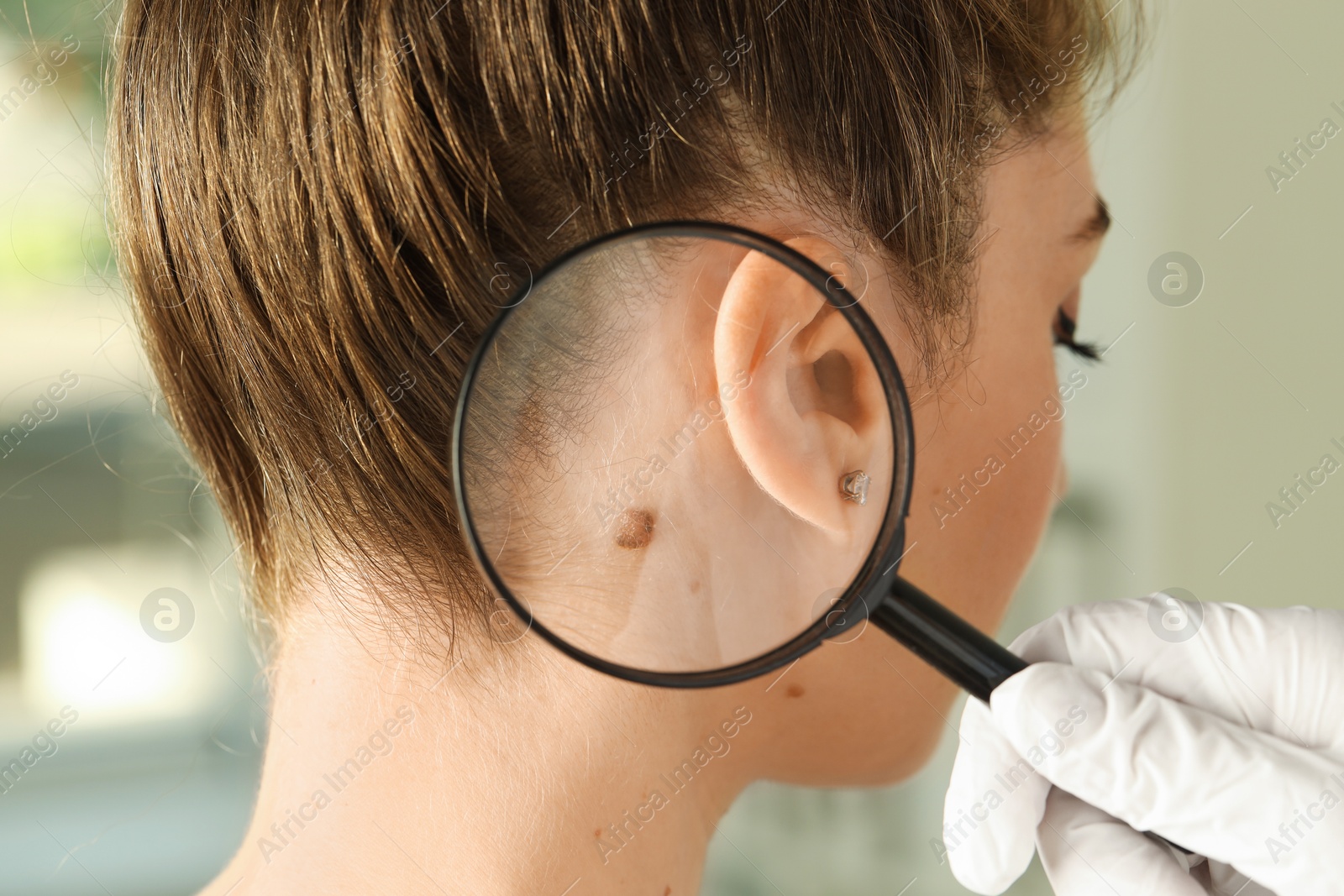 Photo of Doctor examining woman's mole with magnifying glass in clinic, closeup