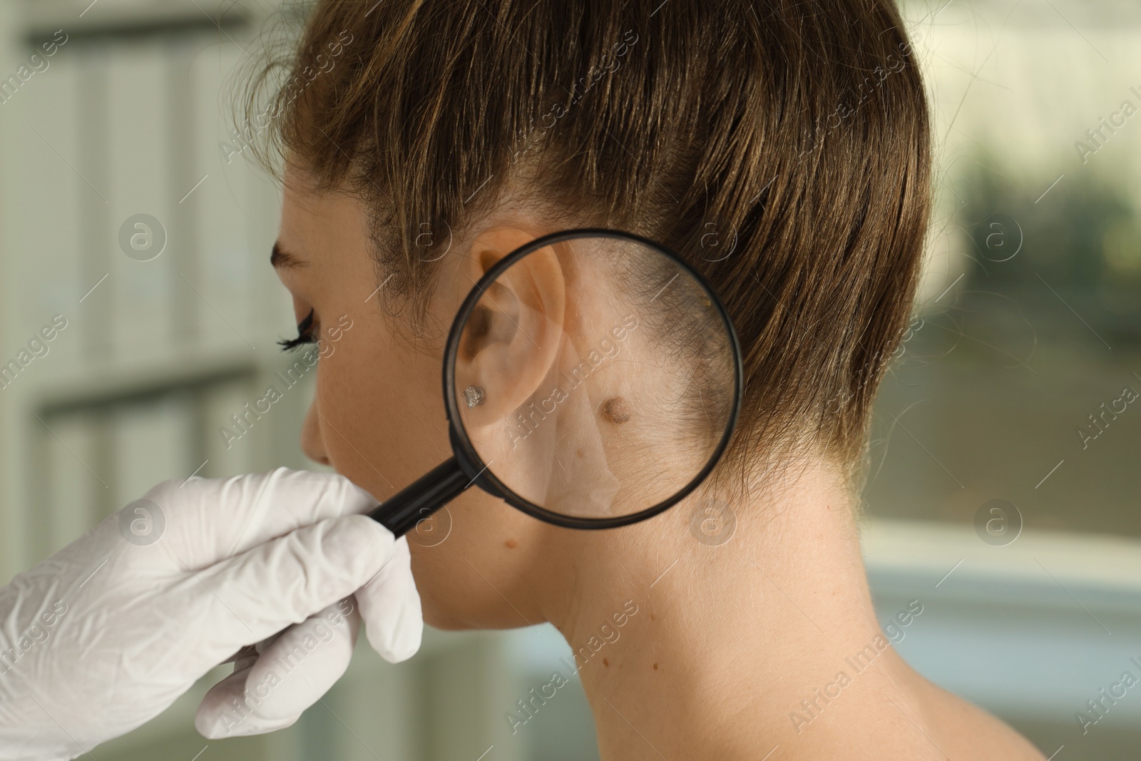 Photo of Doctor examining woman's mole with magnifying glass in clinic, closeup