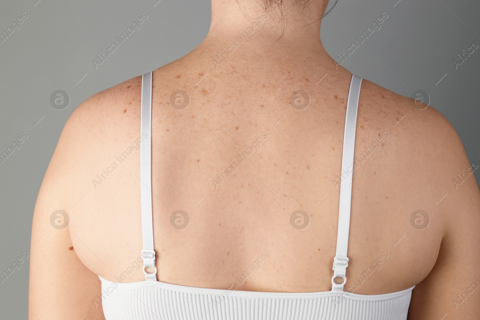 Photo of Woman with birthmarks on her skin against grey background, closeup