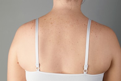 Woman with birthmarks on her skin against grey background, closeup