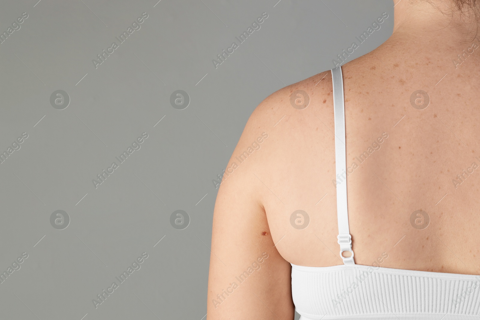 Photo of Woman with birthmarks on her skin against grey background, closeup. Space for text