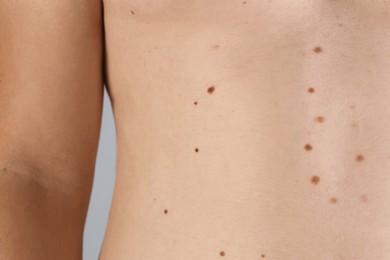 Photo of Man with birthmarks on his skin against grey background, closeup