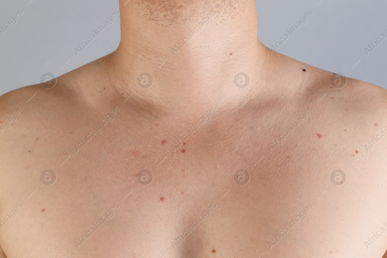 Photo of Man with birthmarks on his skin against grey background, closeup