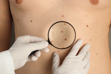 Dermatologist examining patient's birthmarks with magnifying glass, closeup