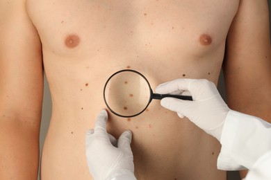 Photo of Dermatologist examining patient's birthmarks with magnifying glass, closeup