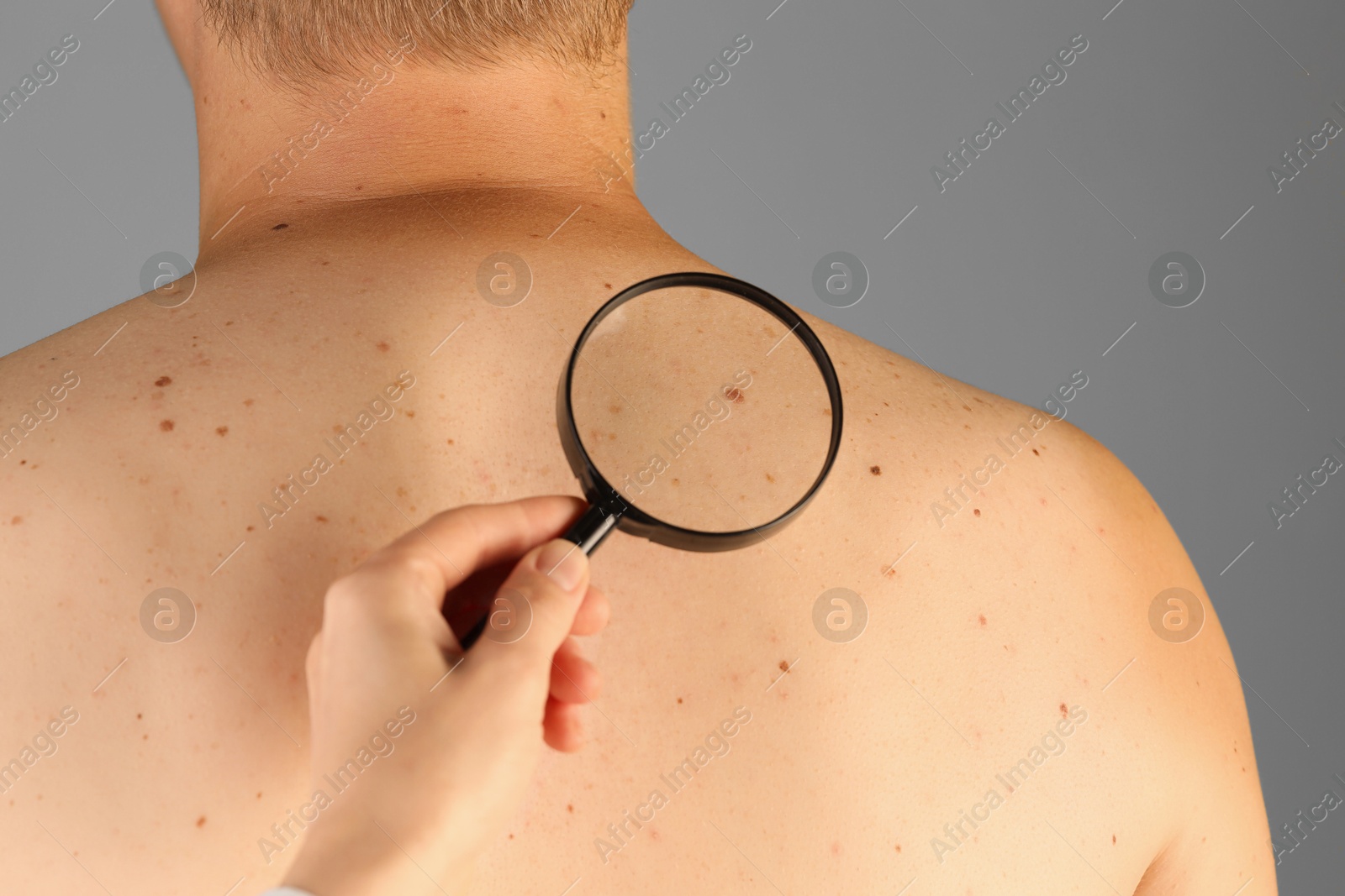 Photo of Dermatologist examining patient's birthmark with magnifying glass on grey background, closeup