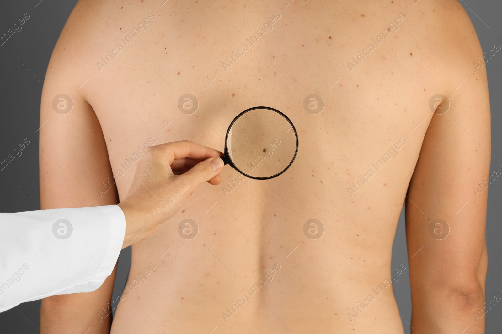 Photo of Dermatologist examining patient's birthmark with magnifying glass on grey background, closeup