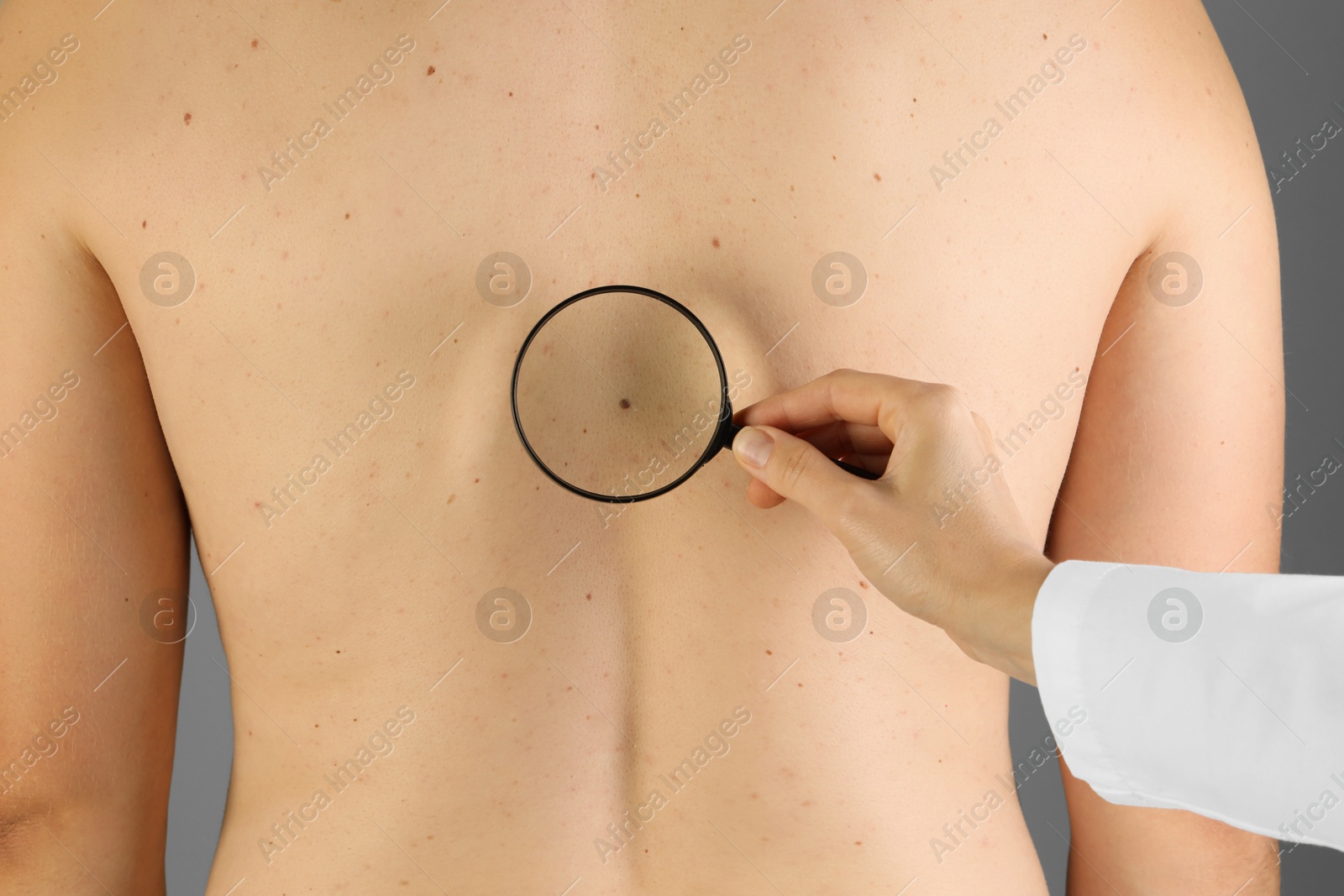 Photo of Dermatologist examining patient's birthmark with magnifying glass on grey background, closeup