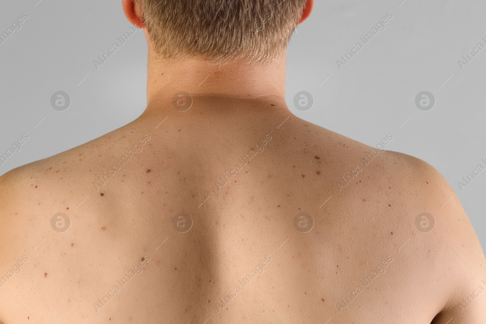 Photo of Man with birthmarks on his skin against grey background, closeup