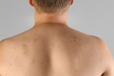 Photo of Man with birthmarks on his skin against grey background, closeup