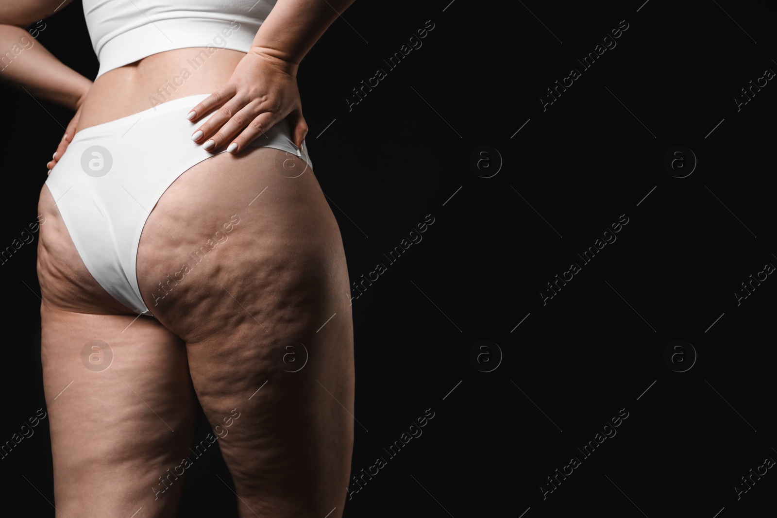 Photo of Woman with cellulite on black background, closeup. Space for text