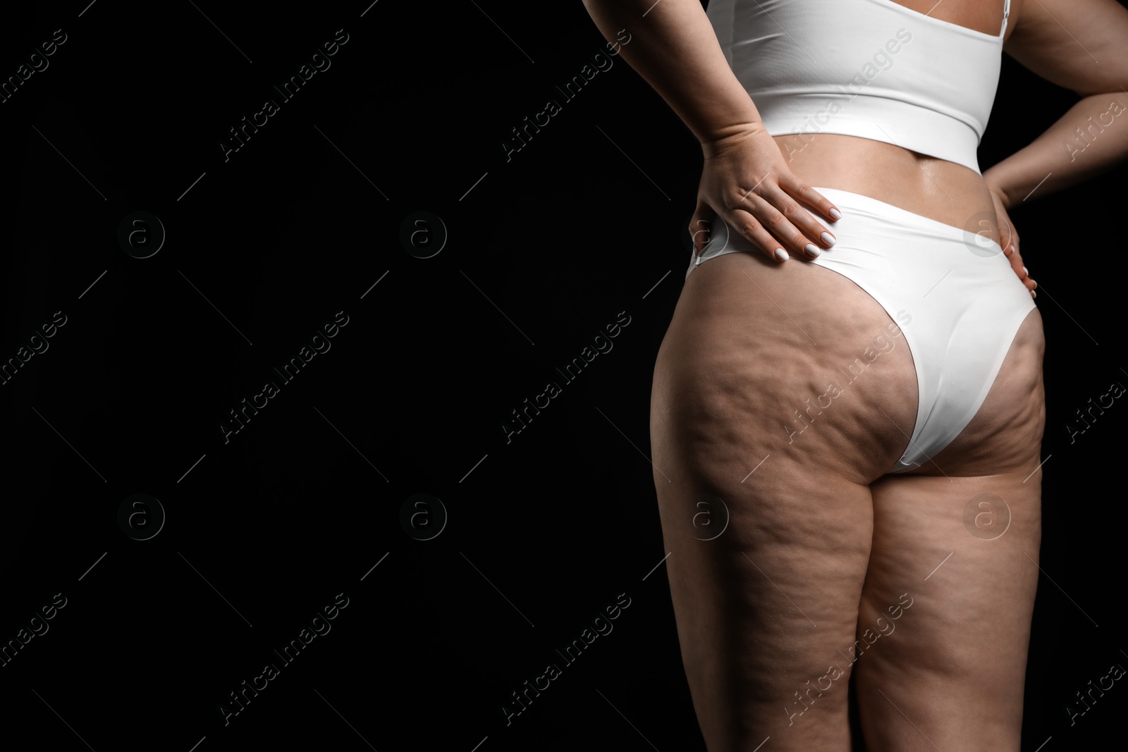 Photo of Woman with cellulite on black background, closeup. Space for text