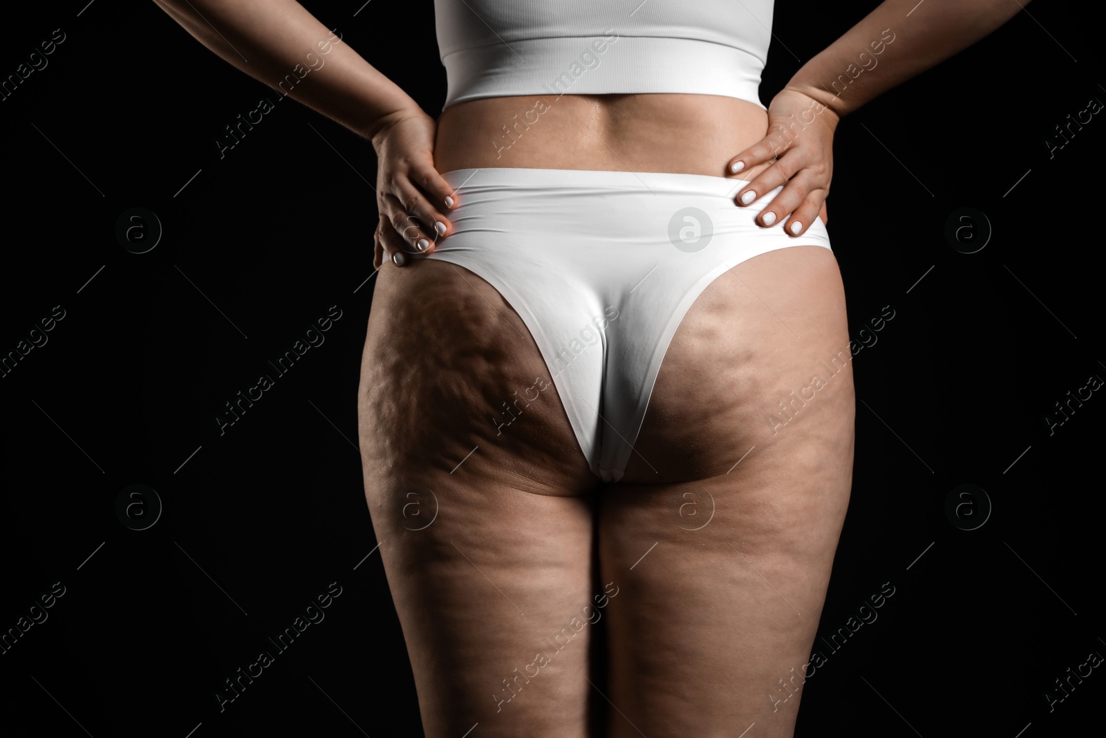 Photo of Woman with cellulite on black background, closeup