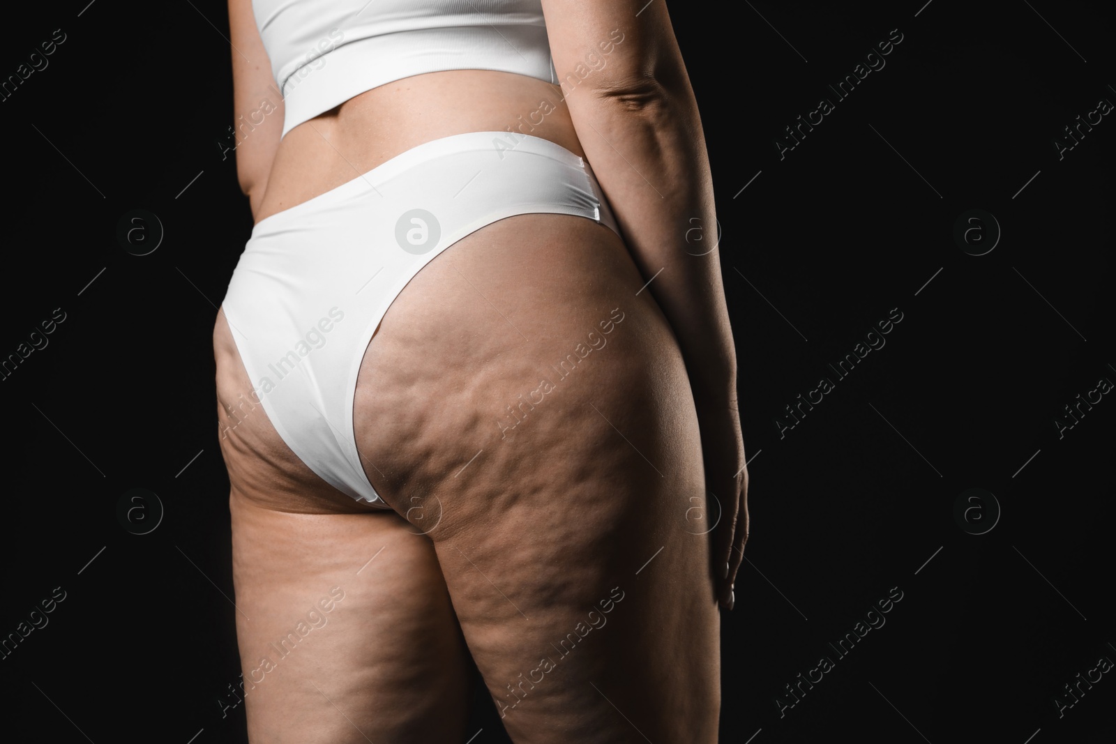 Photo of Woman with cellulite on black background, closeup. Space for text