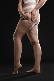 Photo of Woman with cellulite on black background, closeup