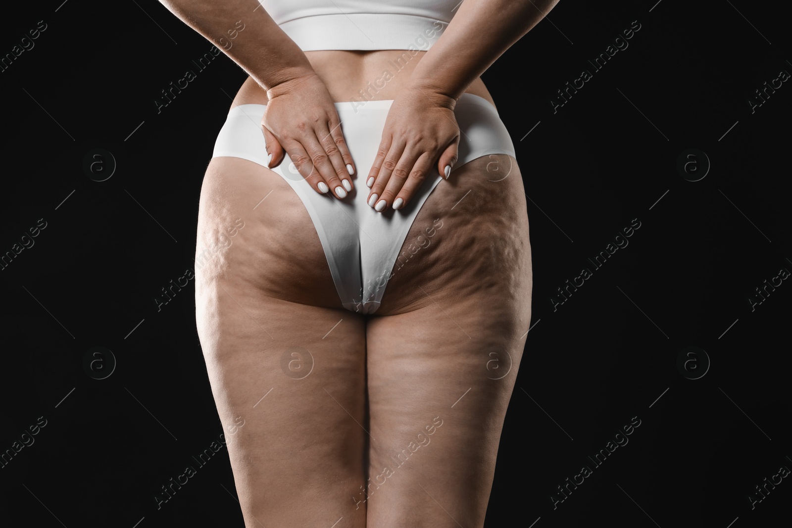 Photo of Woman with cellulite on black background, closeup