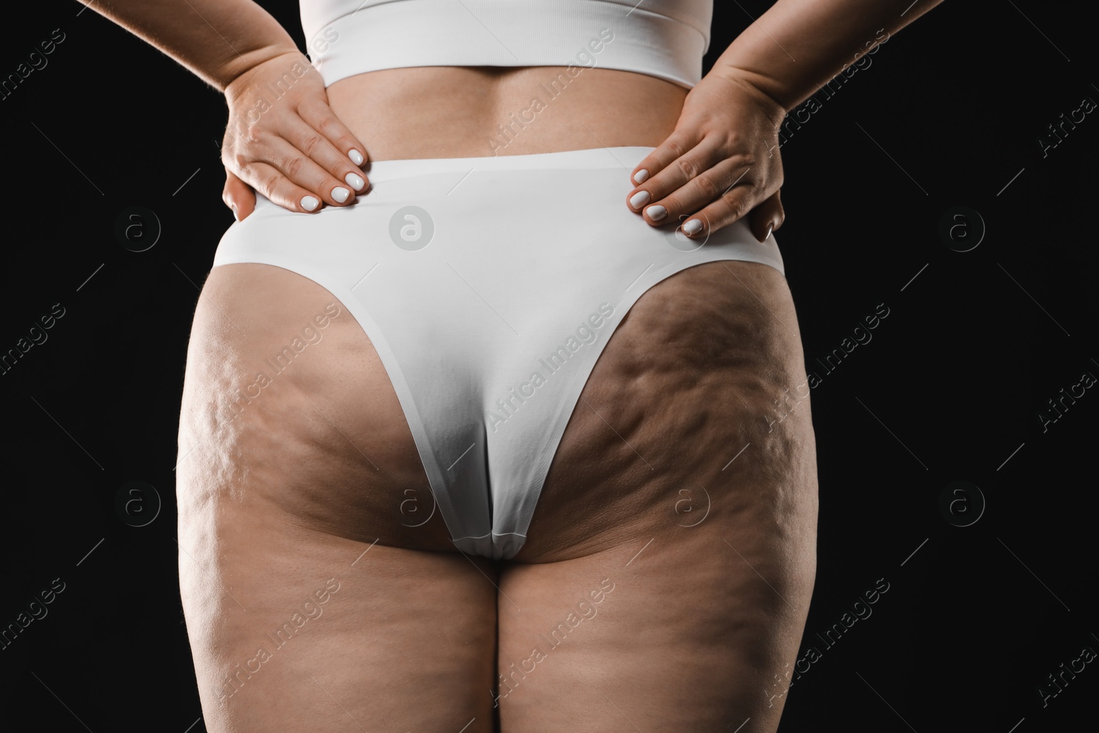 Photo of Woman with cellulite on black background, closeup