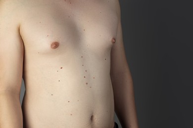 Photo of Man with birthmarks on his skin against grey background, closeup. Space for text