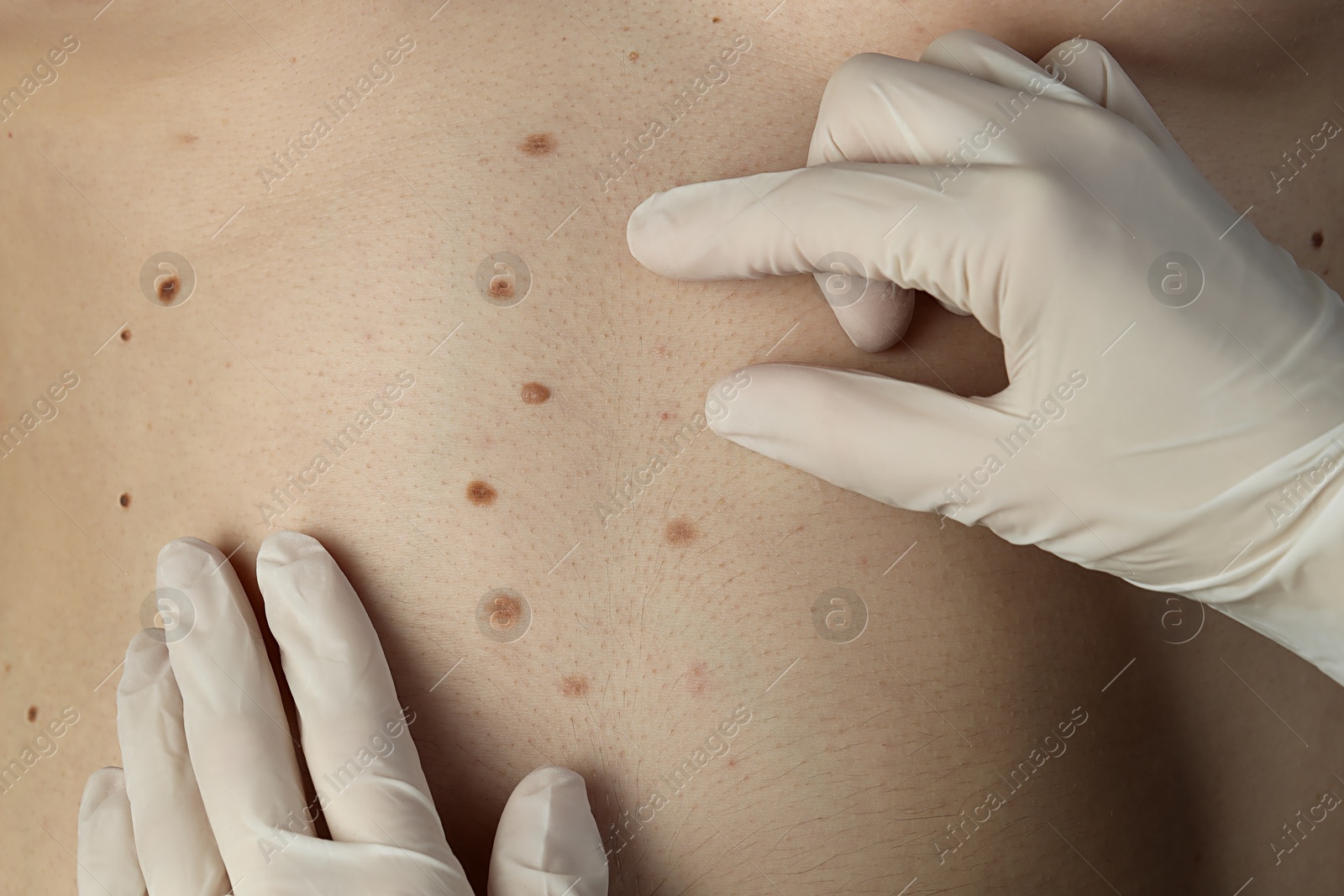 Photo of Dermatologist in gloves examining patient's birthmarks, closeup