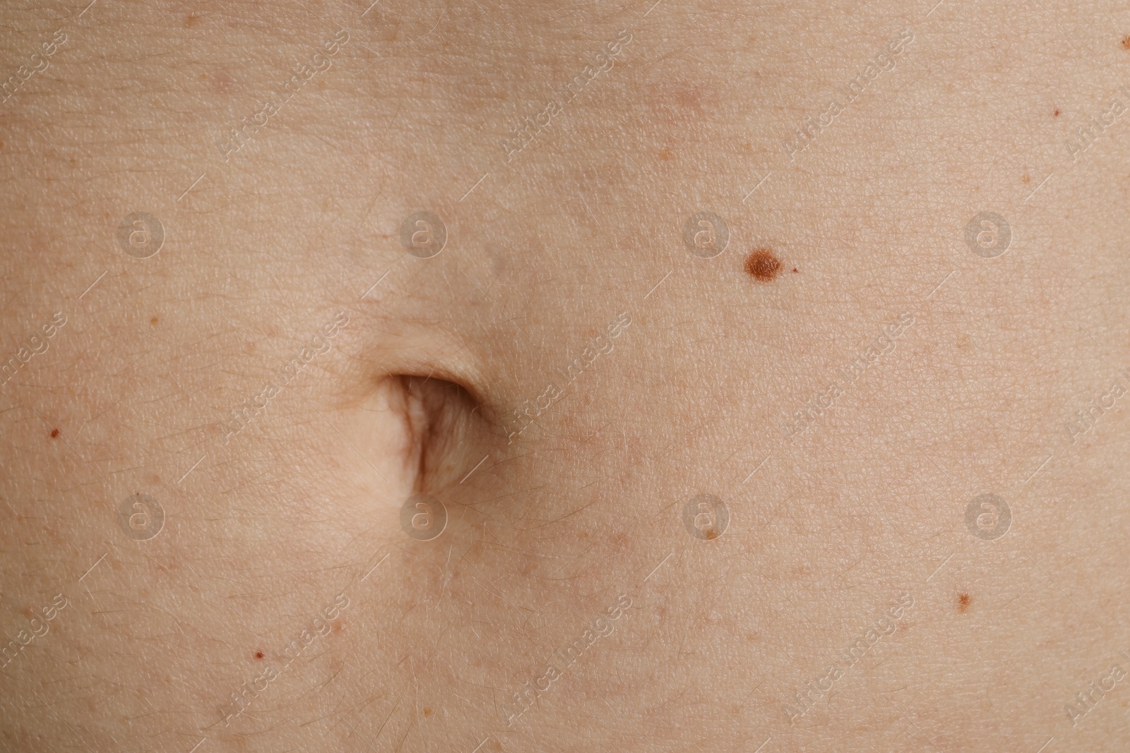 Photo of Woman with birthmark on her skin, closeup