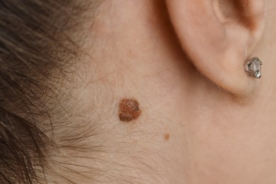 Photo of Woman with birthmark on her skin, closeup