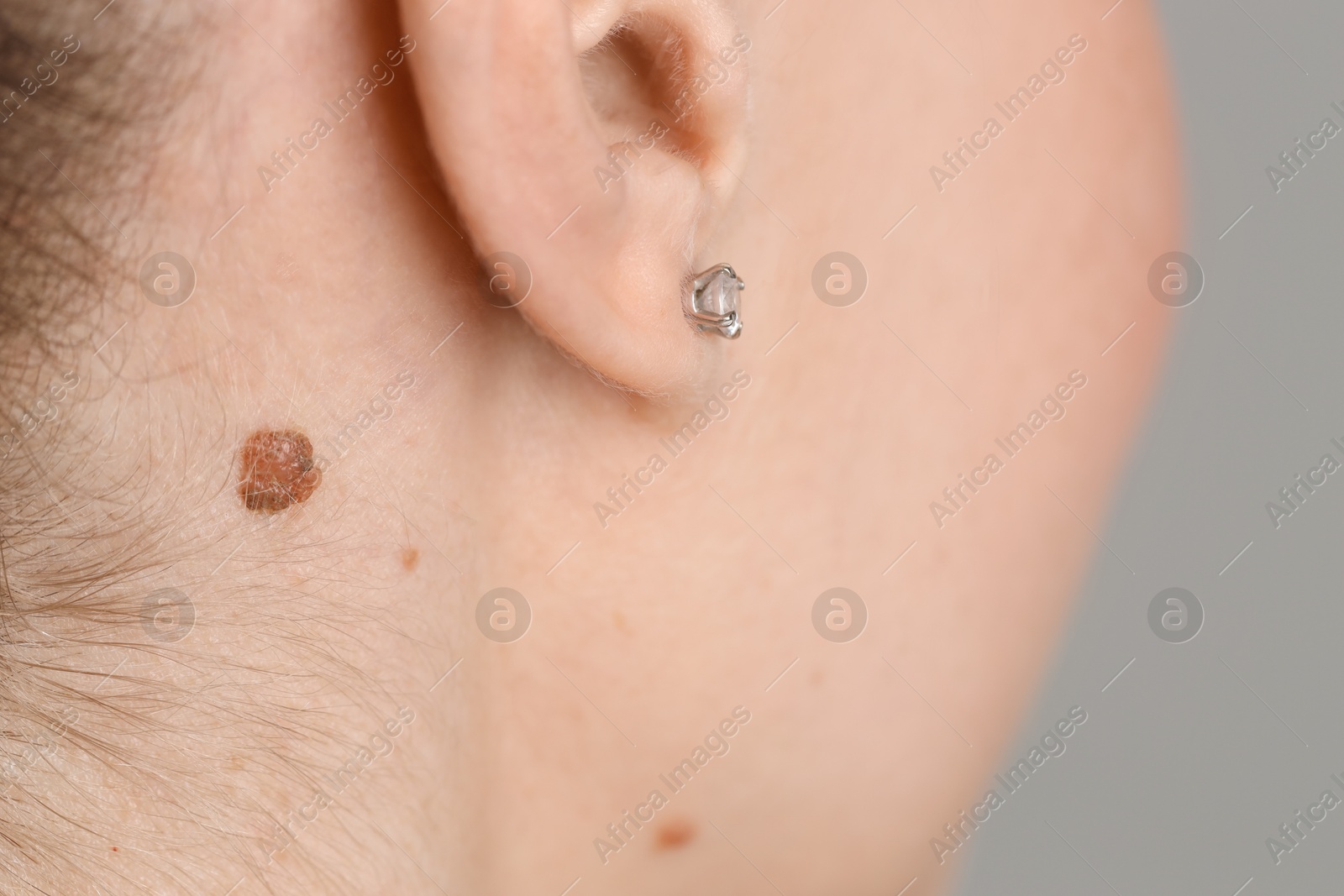 Photo of Woman with mole on her skin against grey background, closeup