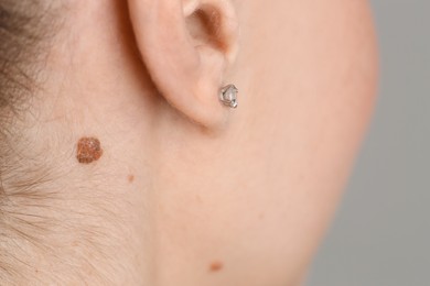 Photo of Woman with mole on her skin against grey background, closeup