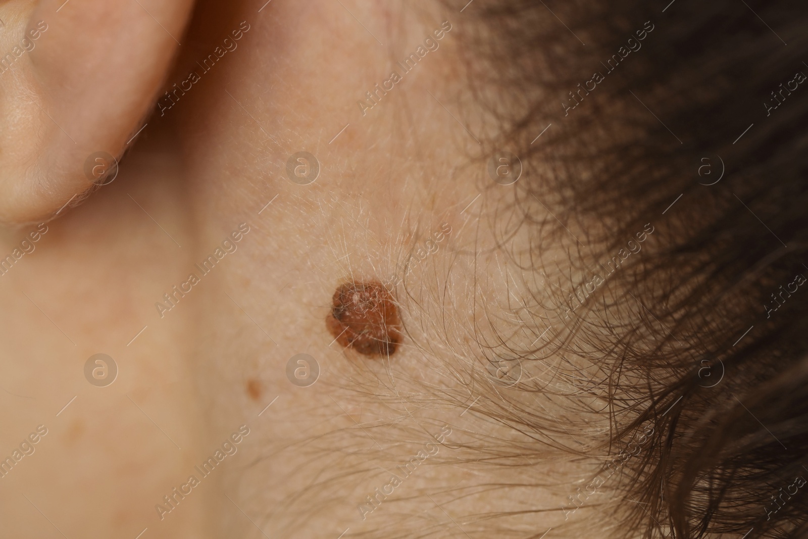 Photo of Woman with birthmark on her skin, closeup