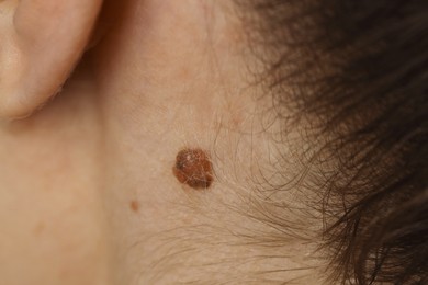 Photo of Woman with birthmark on her skin, closeup