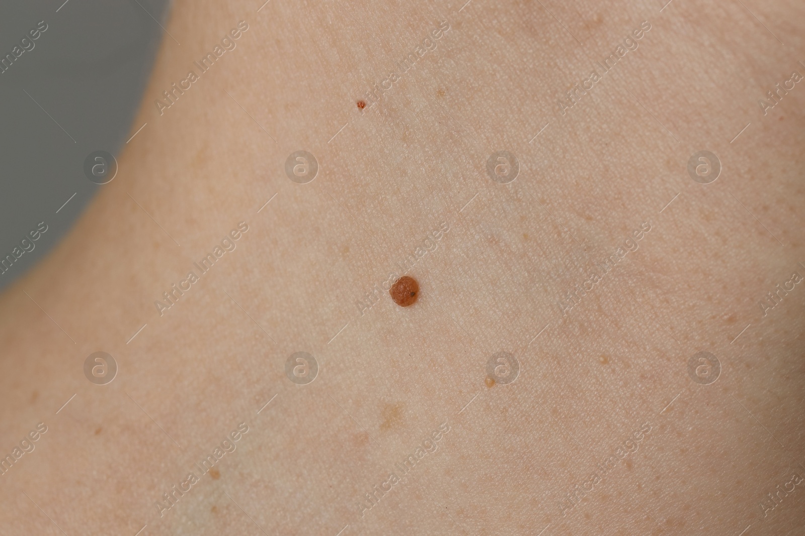 Photo of Woman with birthmark on her skin, closeup