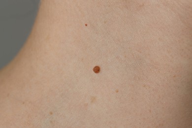 Woman with birthmark on her skin, closeup