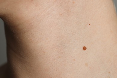 Woman with birthmark on her skin, closeup