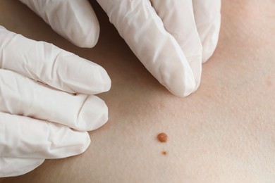 Doctor examining woman's mole in clinic, closeup