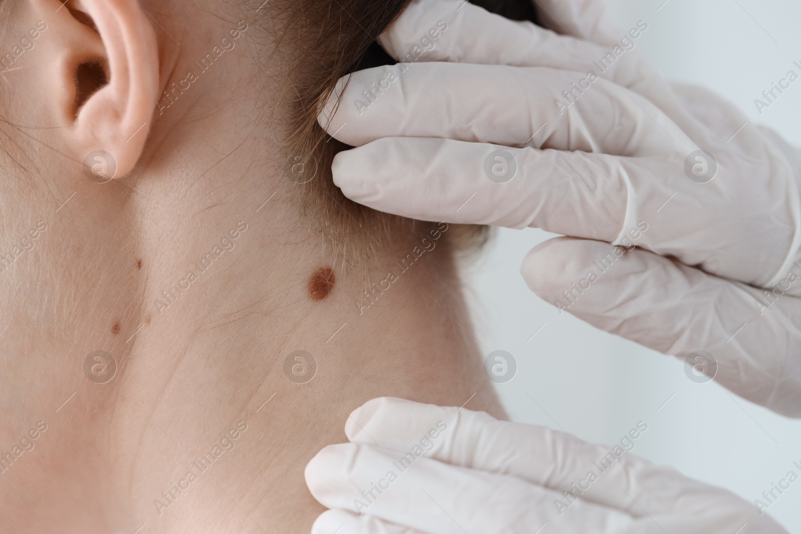 Photo of Doctor examining woman's mole in clinic, closeup