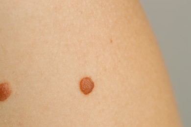 Photo of Woman with moles on her skin against light grey background, closeup