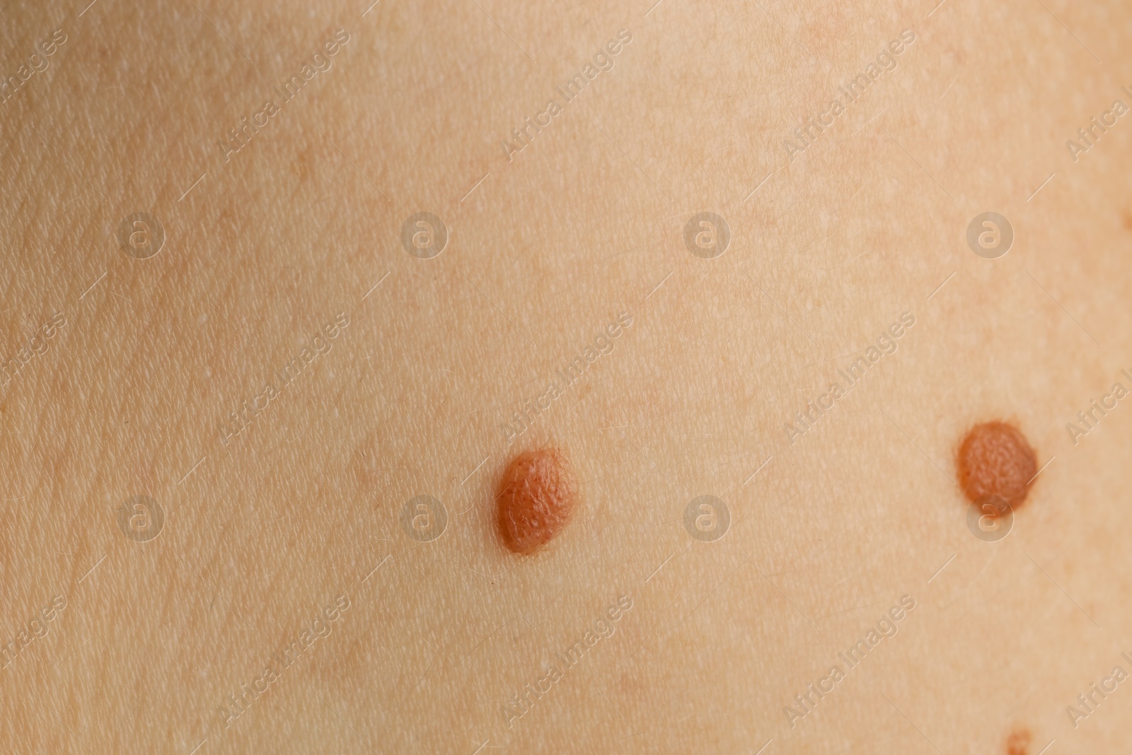 Photo of Woman with moles on her skin, closeup