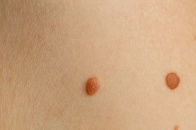 Woman with moles on her skin, closeup