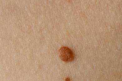 Photo of Woman with moles on her skin, closeup