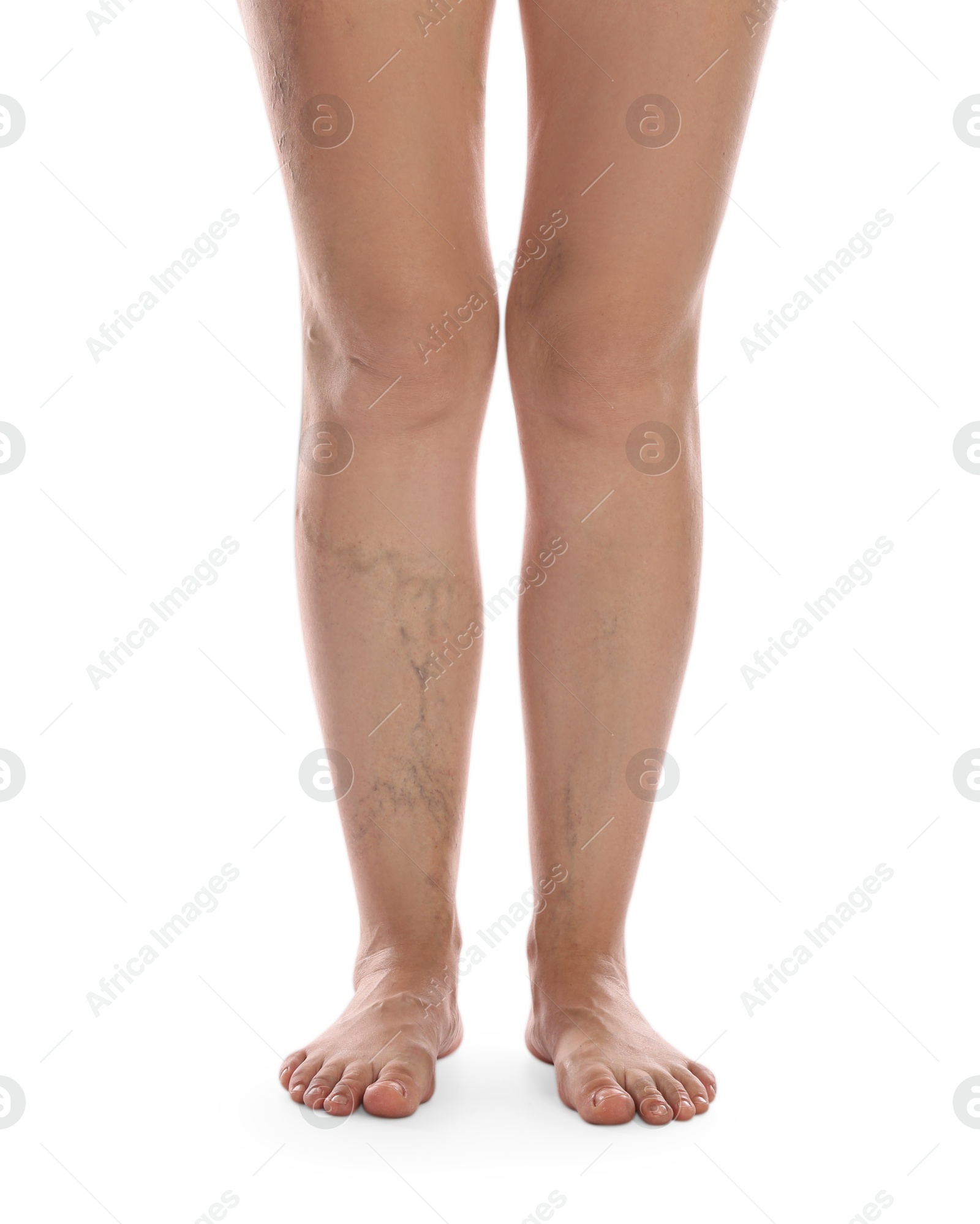 Photo of Woman with varicose veins on white background, closeup