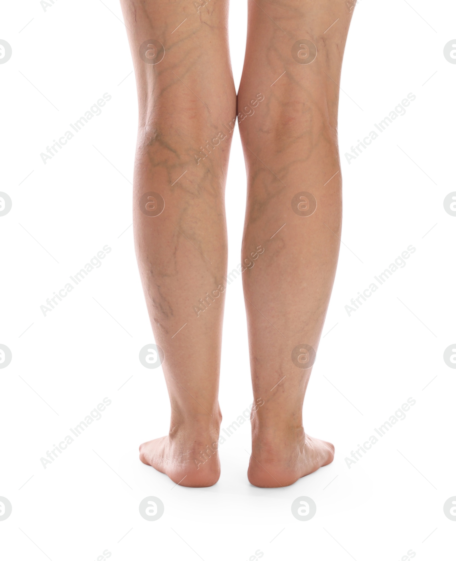 Photo of Woman with varicose veins on white background, closeup