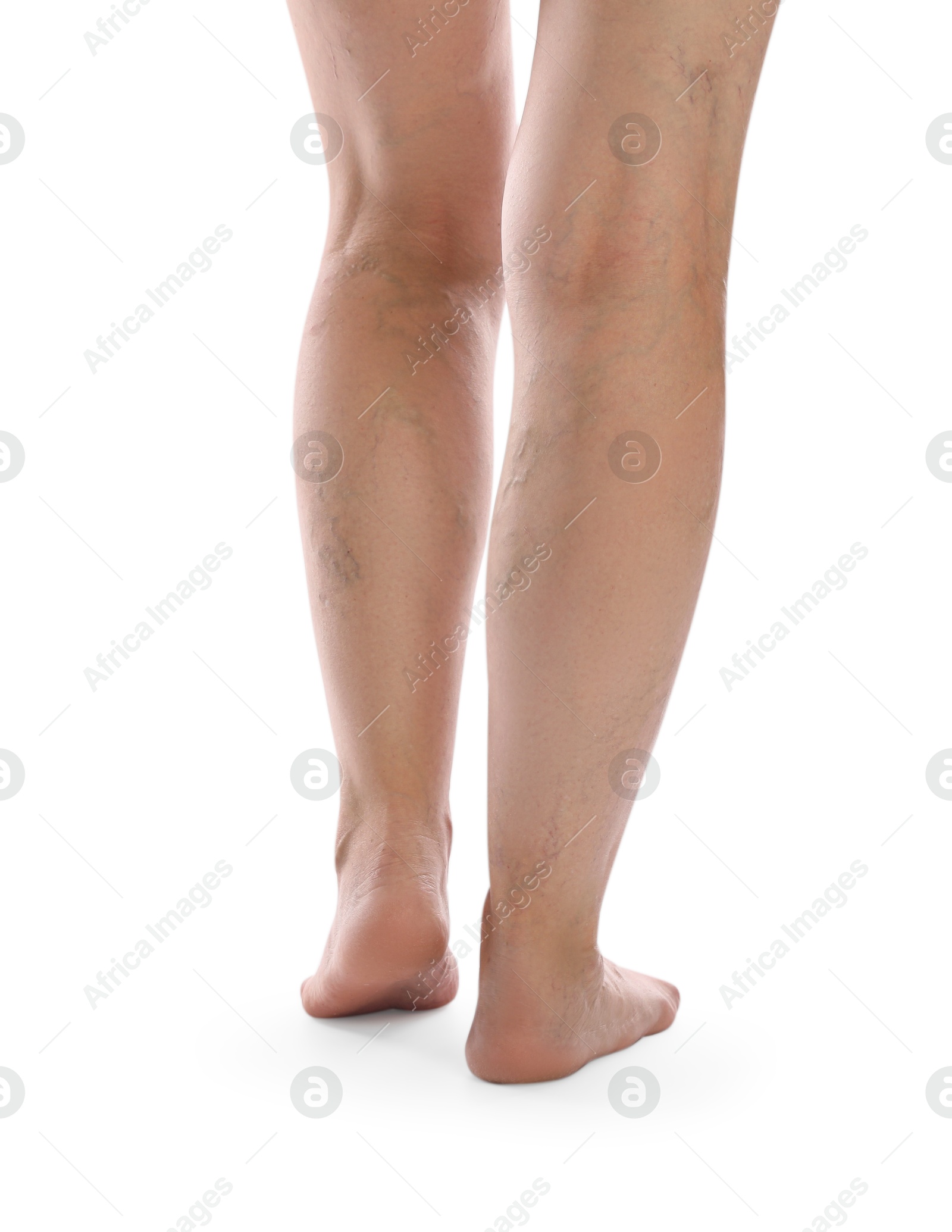 Photo of Woman with varicose veins on white background, closeup