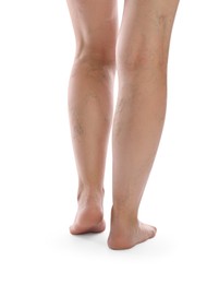 Woman with varicose veins on white background, closeup