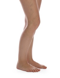 Photo of Woman with varicose veins on white background, closeup