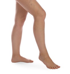 Photo of Woman with varicose veins on white background, closeup