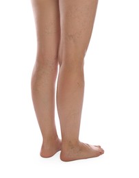 Photo of Woman with varicose veins on white background, closeup