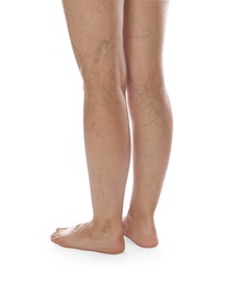 Photo of Woman with varicose veins on white background, closeup