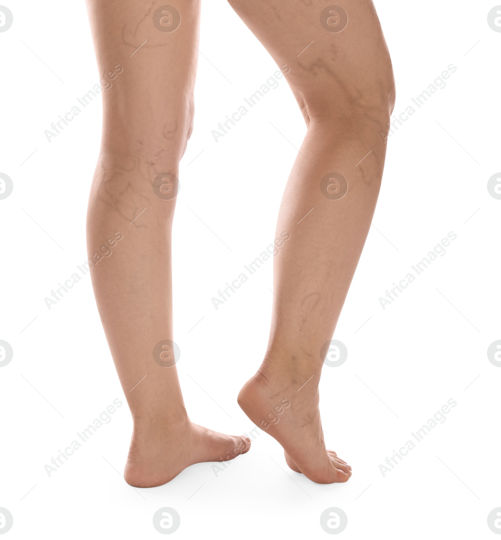 Photo of Woman with varicose veins on white background, closeup