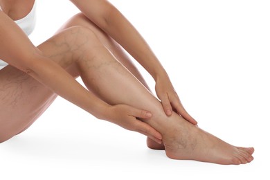 Woman suffering from varicose veins on white background, closeup