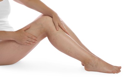 Photo of Woman suffering from varicose veins on white background, closeup