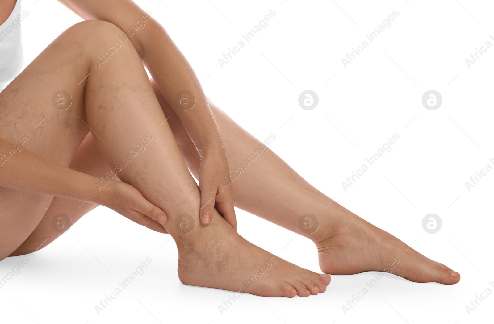 Photo of Woman suffering from varicose veins on white background, closeup